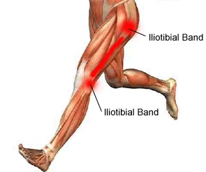 Lopersknie, runner’s knee, iliotibiaal frictiesyndroom, pijn buitenzijde knie