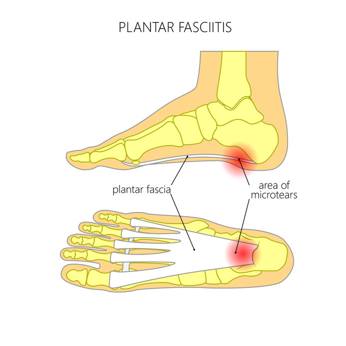 Hielspoor, pees­plaat­ontsteking, Fasciitis plantaris