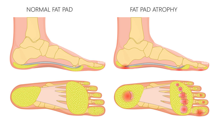 Fat pad atrofie, doortrapte voet