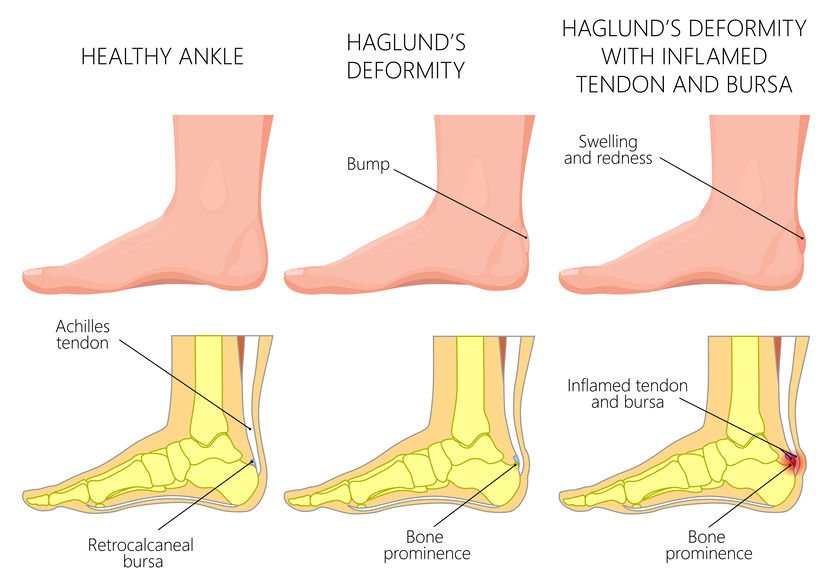 Haglund exostose