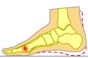 Hallux Limitus, hallux rigidus