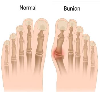 Hallux valgus