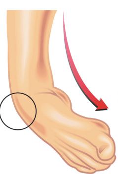 Inversie­trauma, eversie­trauma, verstuiking of omslaan van de enkel