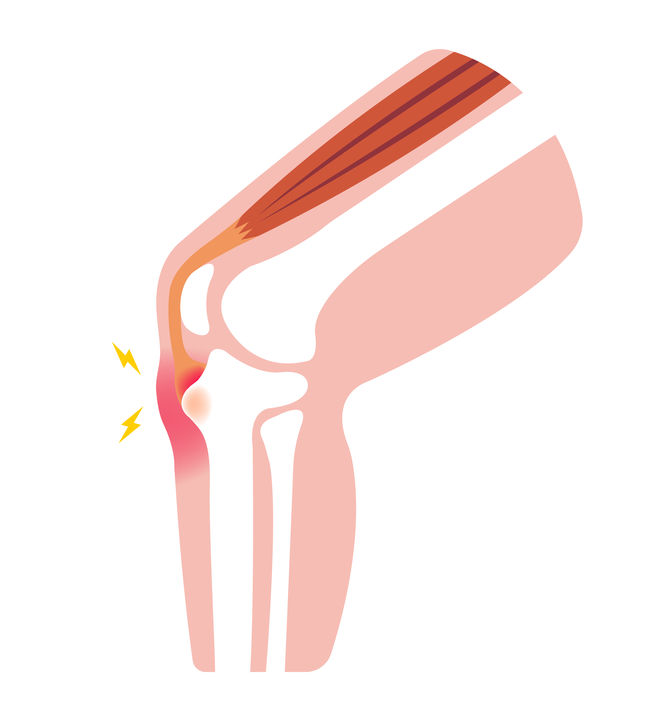 Osgood-schlatter, osteochondrose, groeipijn knie