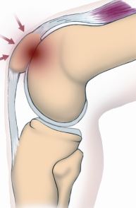 Patella­femoraal pijn­syndroom, pijn knieschijf