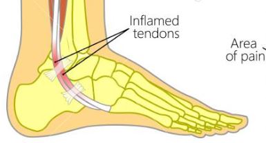 Peroneus pees tendinopathie (ontsteking)