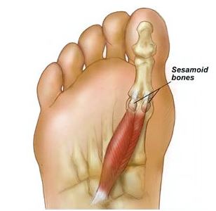 Sesamoïditis, ontsteking van de sesambeentjes