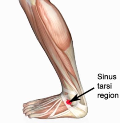 Sinus tarsi syndroom