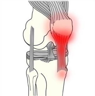 Snapping patella, subluxatie van de patellapees