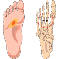 Stressfractuur, marsfractuur, vermoeidheids­fractuur