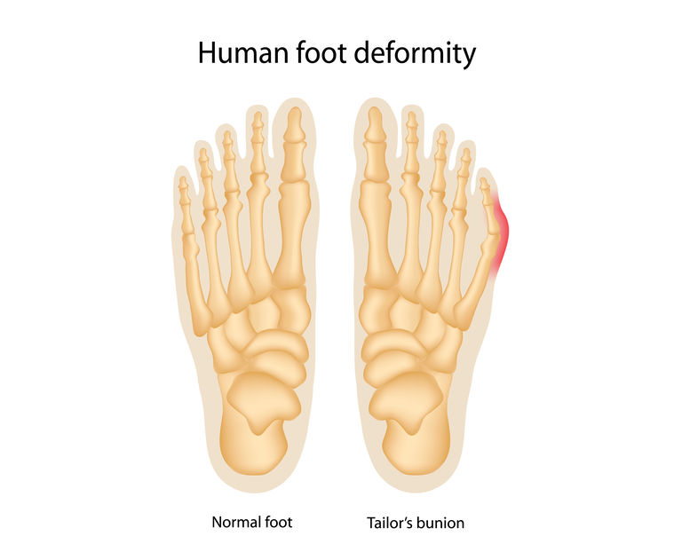 Tailor's bunion